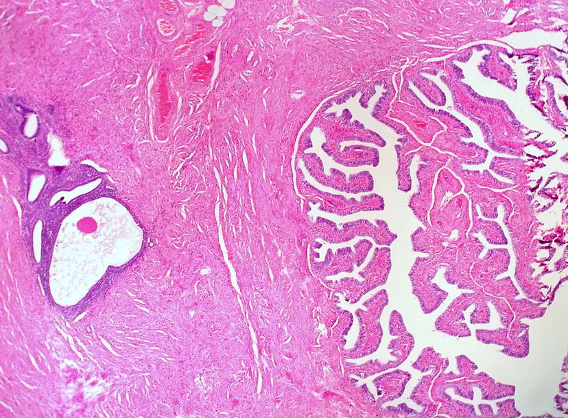 Endometriosis in the wall of the fallopian tube 