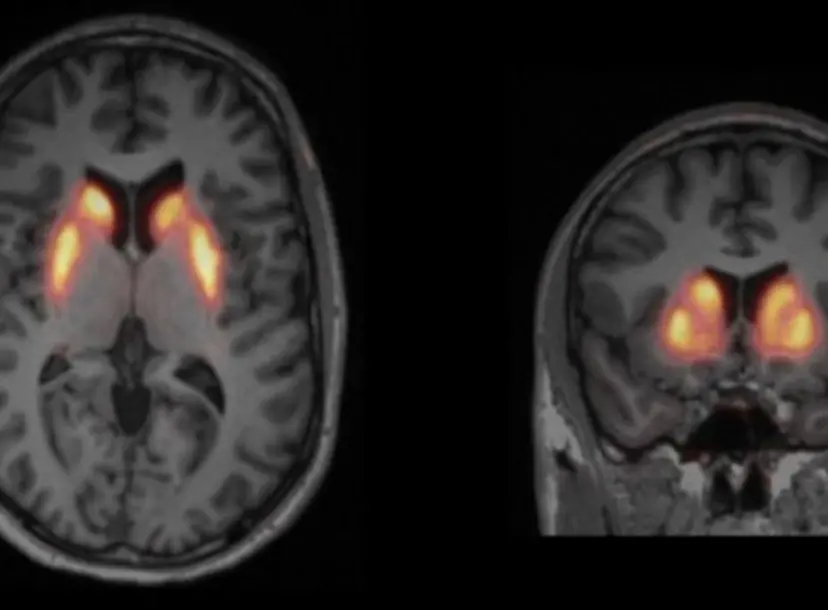 Image of a PET scan