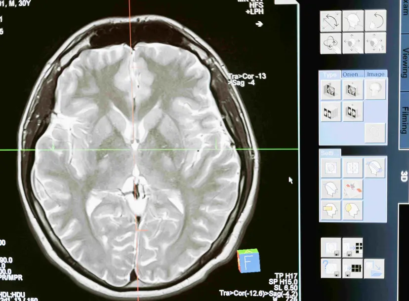 CT scan of a cross section of the brain