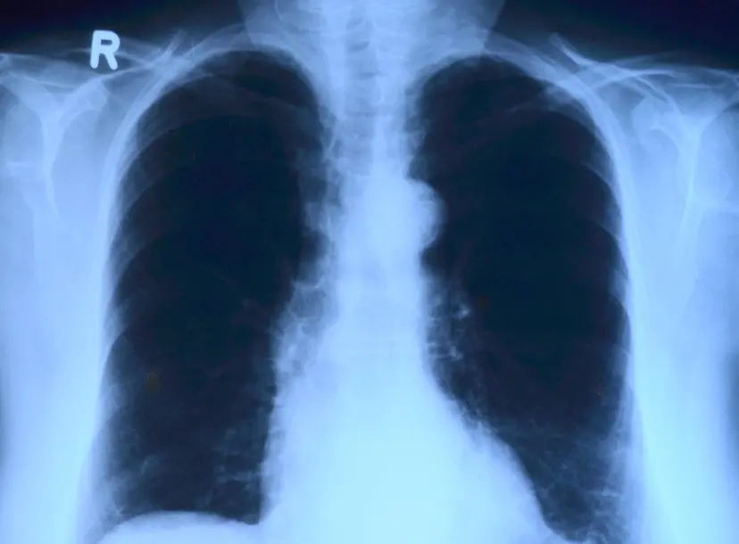 Image of lung x-ray