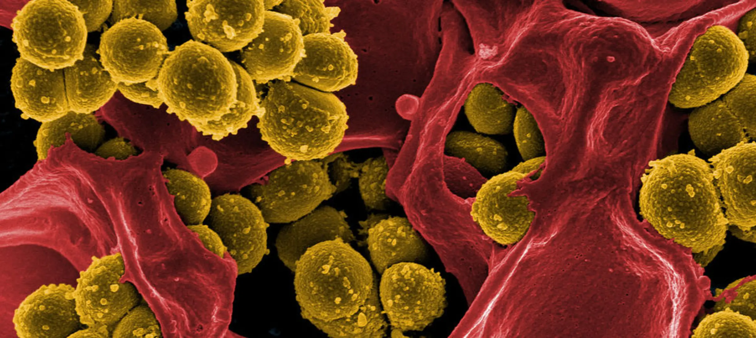 Scanning electron micrograph of methicillin-resistant Staphylococcus aureus and a dead human neutrophil. 