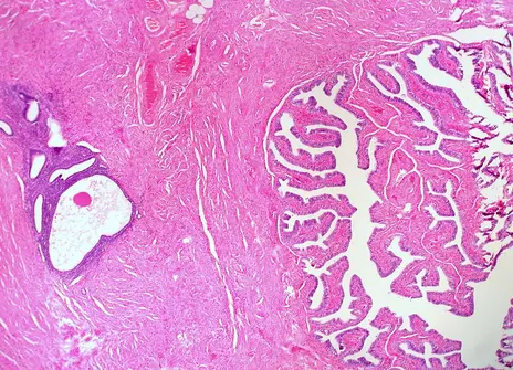 Endometriosis in the wall of the fallopian tube 
