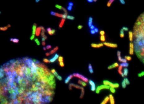 brain cancer chromosomes