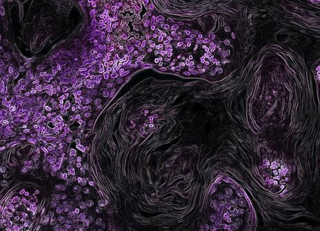 Purple-coloured cancer cells in a lung.