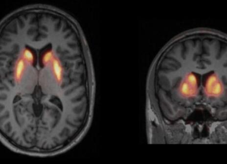 Image of a PET scan
