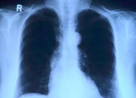 Image of lung x-ray